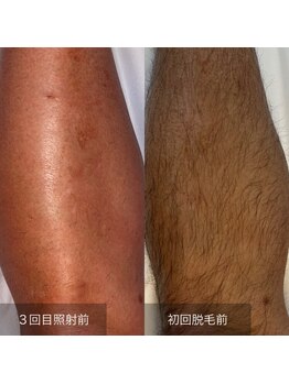 ビューティリュクス(beauty luxe)/全身脱毛