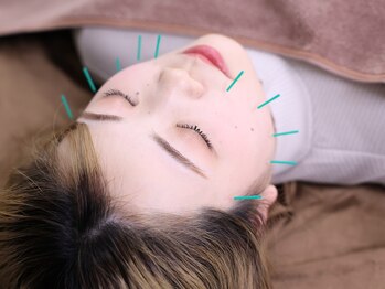 フレッシュ(Fresh)/美容鍼