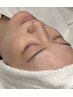 【ニキビ予防】光フェイシャル顔脱毛で毛穴ケア♪スキンケア浸透力UP/越谷