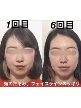 経堂鍼灸整体院/頬~フェイスラインがスッキリ