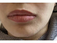 アマカ(amaca)の雰囲気(お口周りにあご周り、気になる「毛」はないですか?)