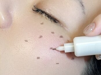 エンルーチェ(enluce)の写真/【シミケア当て放題¥4,950~】低周波シミケアマシン15分あて放題×フォト美顔×高濃度プラセンタパック