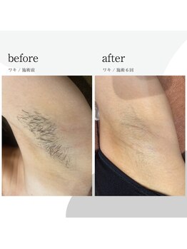 コンフォート ヤマガタ イン ショウナイ(comfort yamagata in shonai)/ワキ脱毛before/after