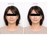 [人気No2]引き上げ特化コース+ヘッドスパ/年齢悩みのシワたるみ◆小顔矯正
