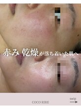 ココリール/乾燥肌・赤み