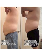 クールスパ(COOL SPA)/男性お腹症例