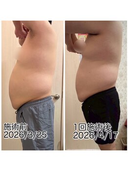 クールスパ(COOL SPA)/男性お腹症例