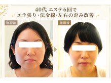 サロンドエステケイワイ(de KY)の雰囲気(40代エラ張り・法令線・左右の歪みを6回で改善四角顔から卵型に)