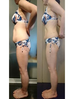 レナトゥス 銀座(Renatus)/お腹＊Before/After【痩身】