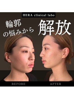 ヘラ クリニカルラボ(HERA)/水玉リフティング