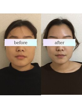 小顔革命 小顔 全身美容矯正専門店/小顔矯正+顎関節矯正