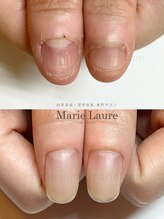マリーロール 梅田店(Marie Laure)/自爪育成/深爪矯正/ネイルケア