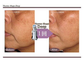 Nビューティー/最新RFサーモシェイプオーパス