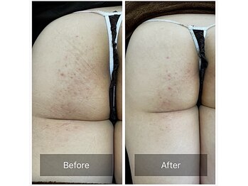 ルナート(Lunart)/ハーブピーリング【でん部】