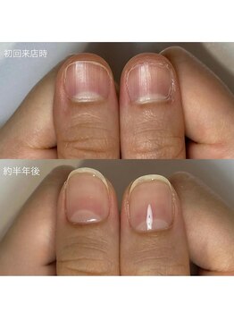 ティアラネイル 宇都宮/深爪矯正