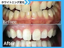 鹿児島ホワイトニング/Before→After