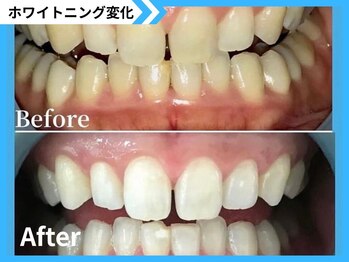 鹿児島ホワイトニング/Before→After