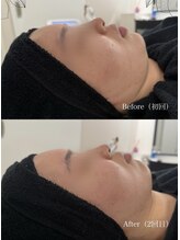 ウルト(ULT)/レモンボトルBeforeAfter