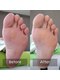 ニコルル 富田林店(Nicolulu)の写真/痛みを最小限に！古い角質を取り除くだけではなく、【たこ・魚の目】も同時にケア☆肩コリ、腰痛改善も◎