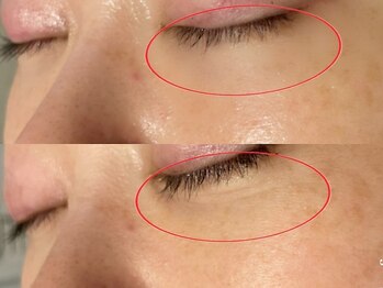 アイリープ(eyeleap)/☆目元美人(クマ・たるみ改善)