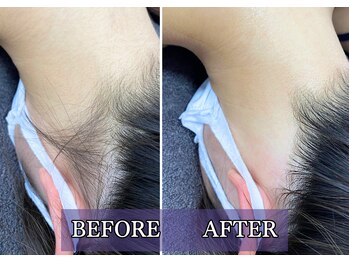 ルブレ Ginza5店(RUBURE)/【襟足脱毛ビフォアフター】