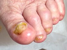 001 新横浜/分厚い変形爪も一回でキレイ