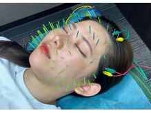 久喜駅前鍼灸整骨院/美容鍼は男女問わずおすすめ☆