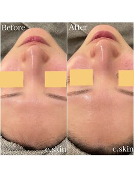 シースキン 盛岡駅前店(c.skin)/お客様ビフォーアフター♪