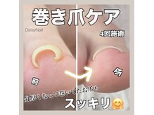 デイジーネイル(Daisy Nail)の雰囲気（《足の爪の形でお悩みの方へ》B/Sまき爪補正＋足爪ネイルケア）