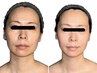 【エラ張り解消】噛みしめ・食いしばり改善×骨格小顔矯正