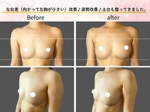 ロットプラス(Lot Plus)/バストアップ症例【C→Fカップ】