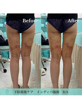 ノット(KNOT)/下肢ダウンタイムBefore/After