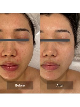 マインエム(mine.m)/刺さないリジュランアンプル