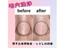 グラシア 宇土店(gracia)の雰囲気（細かいシミも丁寧にケアしていきます。色ムラのないお肌に）