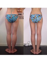 レナトゥス 銀座(Renatus)/BeforeAfter【痩身/美脚/銀座】