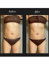 エヌボーテ(N. beaute)/before→afterお腹周り4回目
