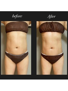 エヌボーテ(N. beaute)/before→afterお腹周り4回目