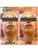 サロンデイジー(Salon Daisy)/Matrix小顔フェイシャル施術一回