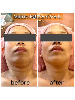 サロンデイジー(Salon Daisy)/Matrix小顔フェイシャル施術一回