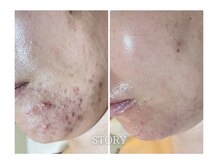 ストーリー 岐阜店(STORY)/ハーブピーリング専門店STORY