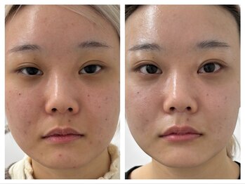 洗顔サロン 池袋(SENGAN)/ハーブピーリング