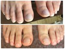 フットネイル改善コース