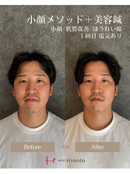ヒノト(Hinoto)/小顔メソッド+美容鍼