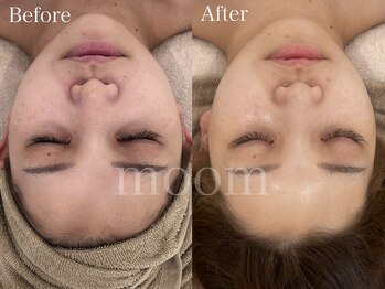 ムーム なんば店(moom)/《新感覚》フォト★フェイシャル