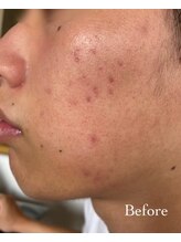 ルナカーザ(LUNACASA)/VOS　ニキビケア Before