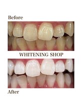 ホワイトニングショップ 岸和田店/お客様のBefore  After