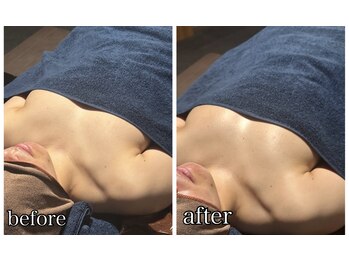 リルマコ/バスト症例写真