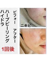 キッカ 梅田天六(Kikka)/悩みに特化したハーブピーリング