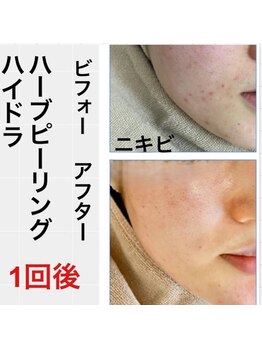 キッカ 梅田天六(Kikka)/悩みに特化したハーブピーリング