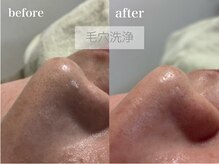 ムスビ(Musubi)の雰囲気（鼻の黒ずみや皮脂の詰まりが気になる方へぴったり！）